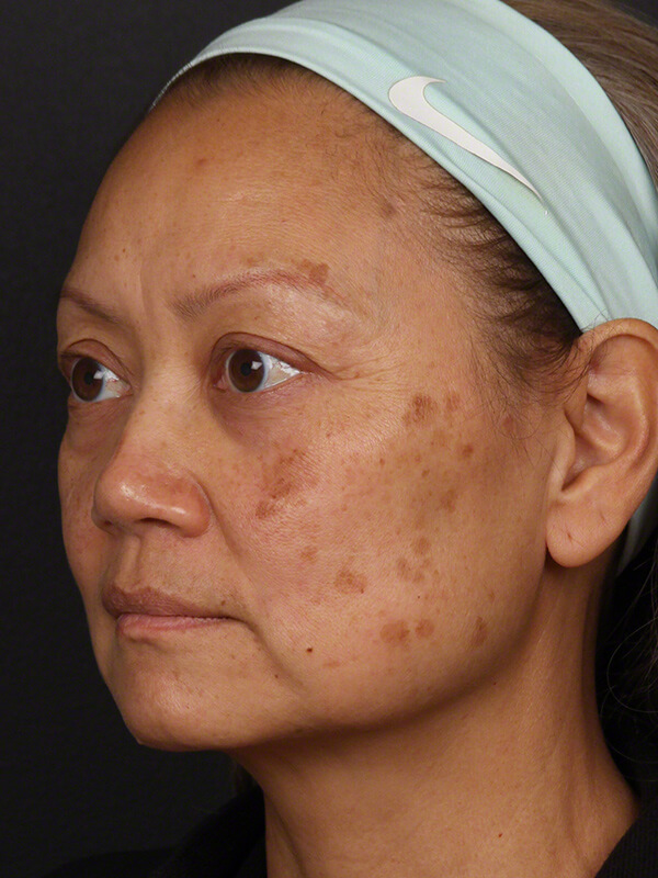 Pigmentation Before & After Image