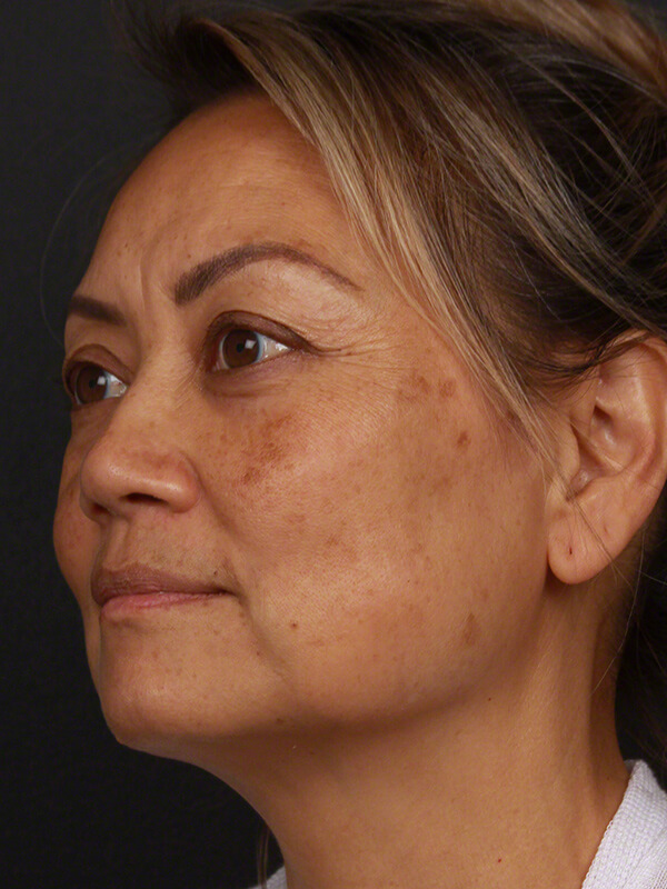 Pigmentation Before & After Image