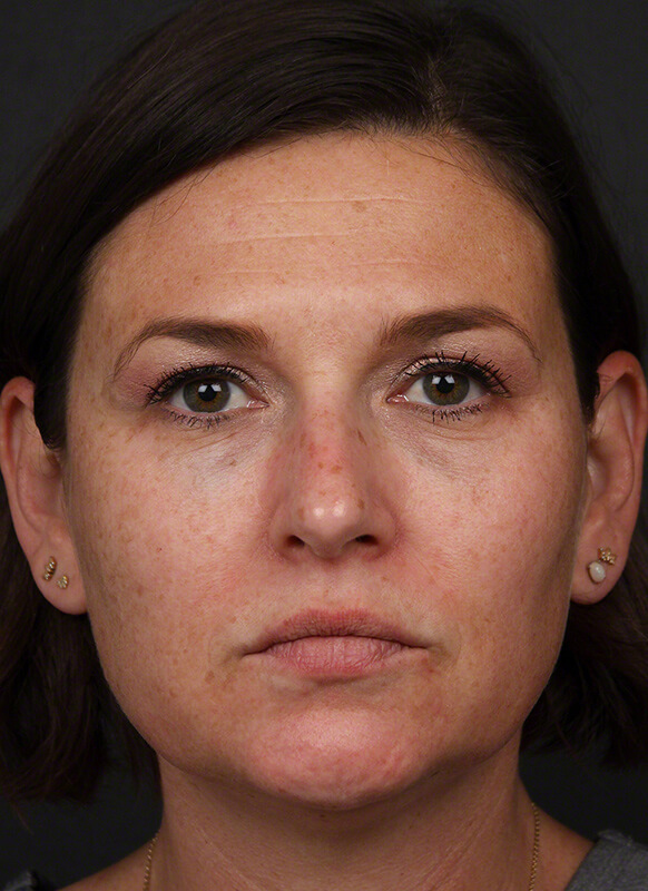 Pigmentation Before & After Image