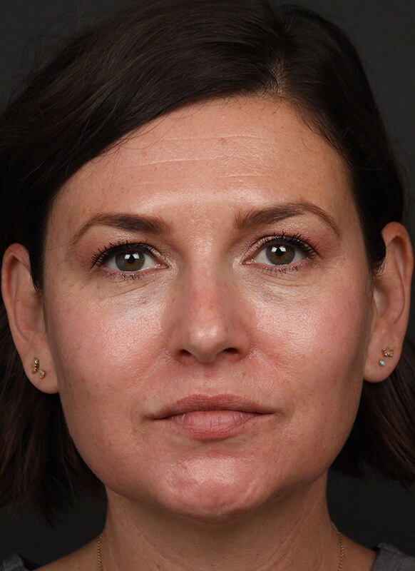 Pigmentation Before & After Image