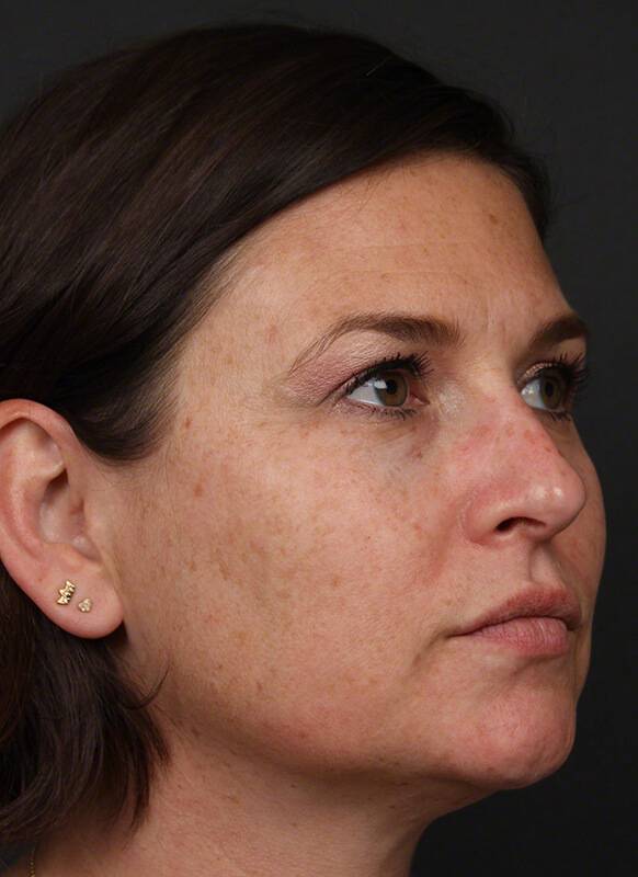 Pigmentation Before & After Image