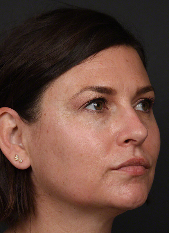 Pigmentation Before & After Image