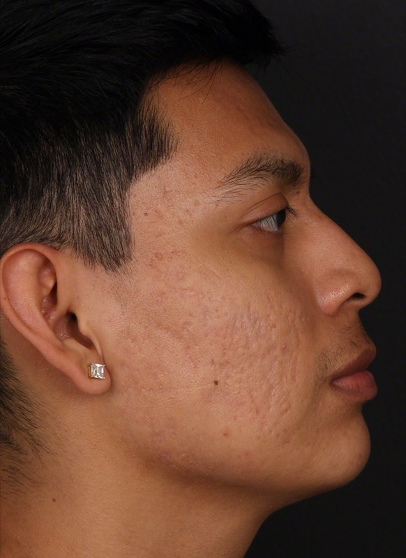 RF Microneedling Before & After Image