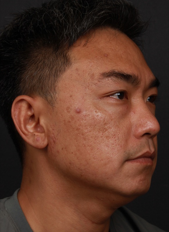 RF Microneedling Before & After Image