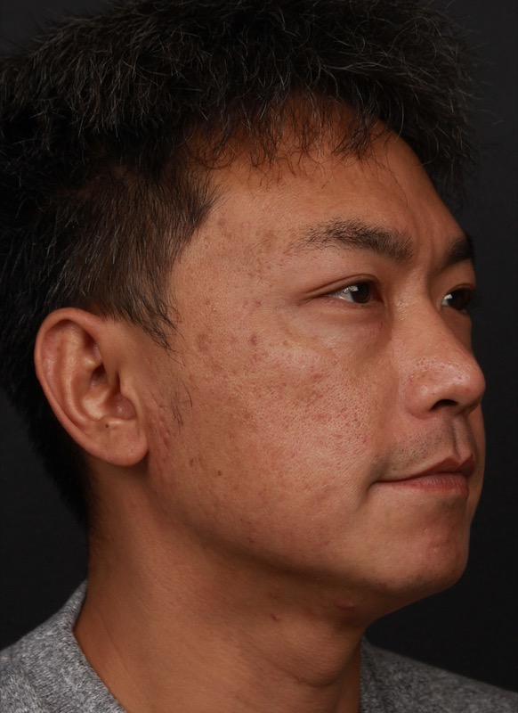 RF Microneedling Before & After Image