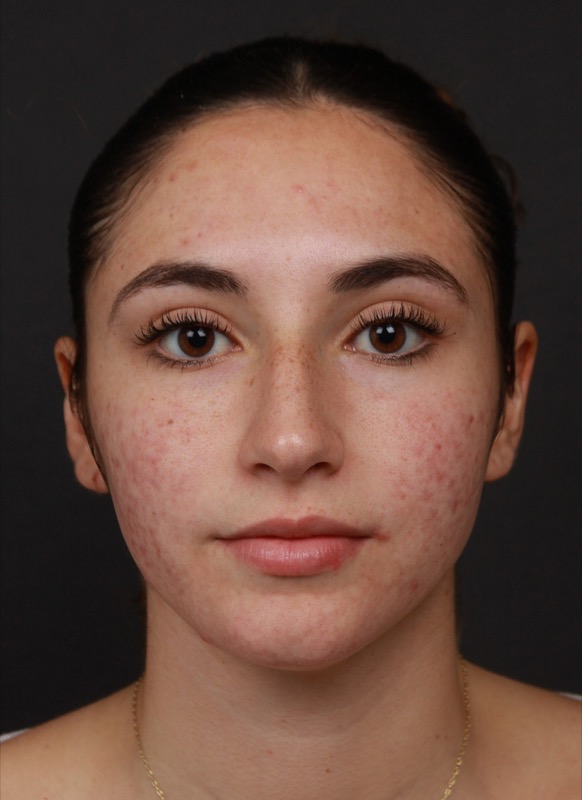 Smoothbeam Before & After Image