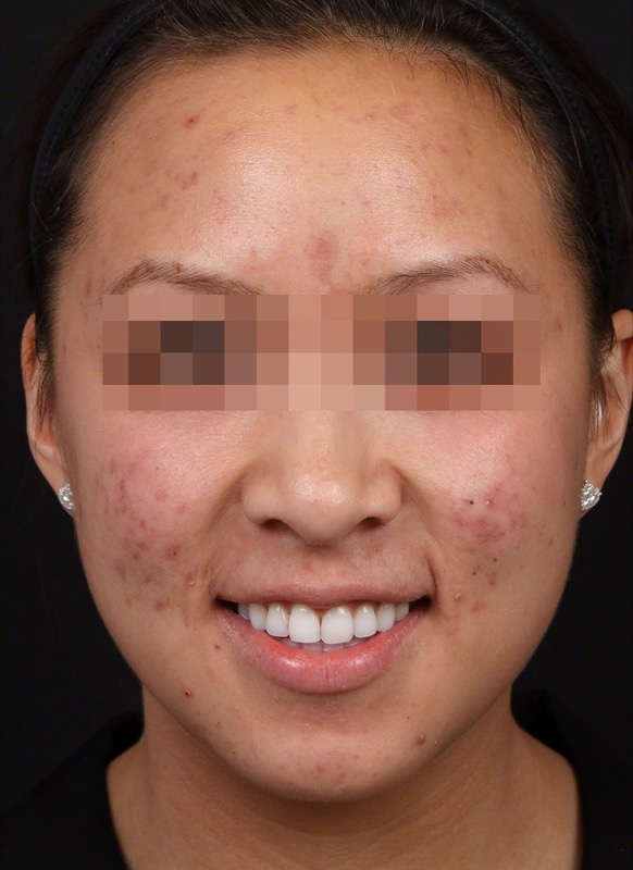 Smoothbeam Before & After Image