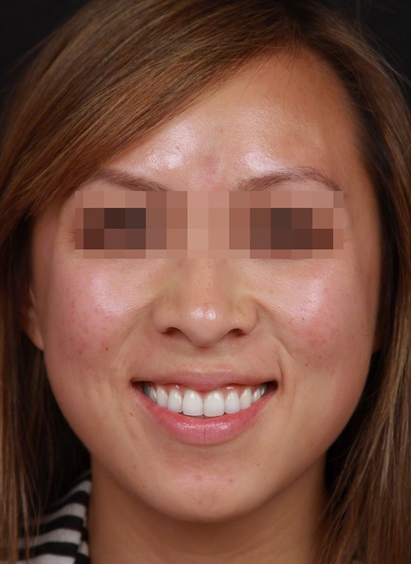 Smoothbeam Before & After Image