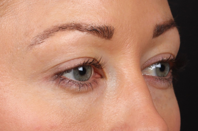 Thermage FLX Before & After Image