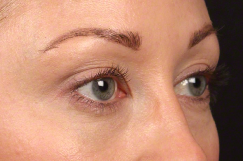 Thermage FLX Before & After Image