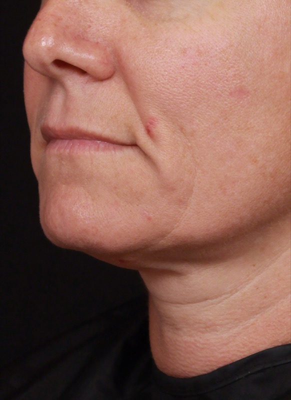 Thermage FLX Before & After Image