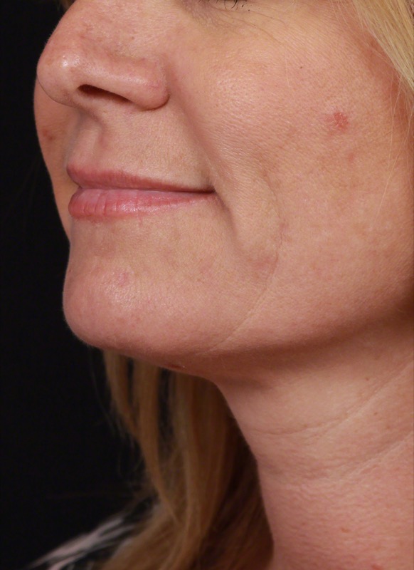 Thermage FLX Before & After Image