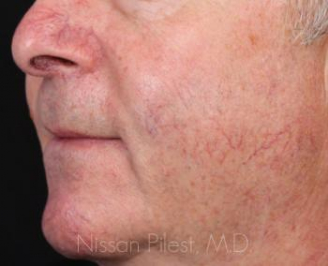 Veins Redness Before & After Image