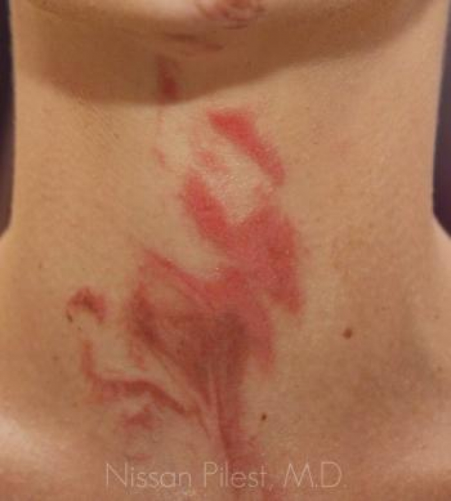 Veins Redness Before & After Image