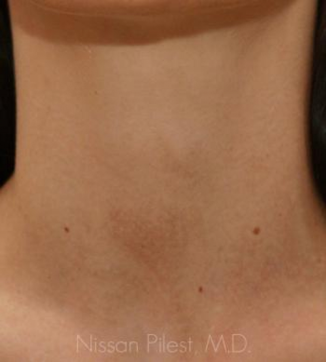 Veins Redness Before & After Image