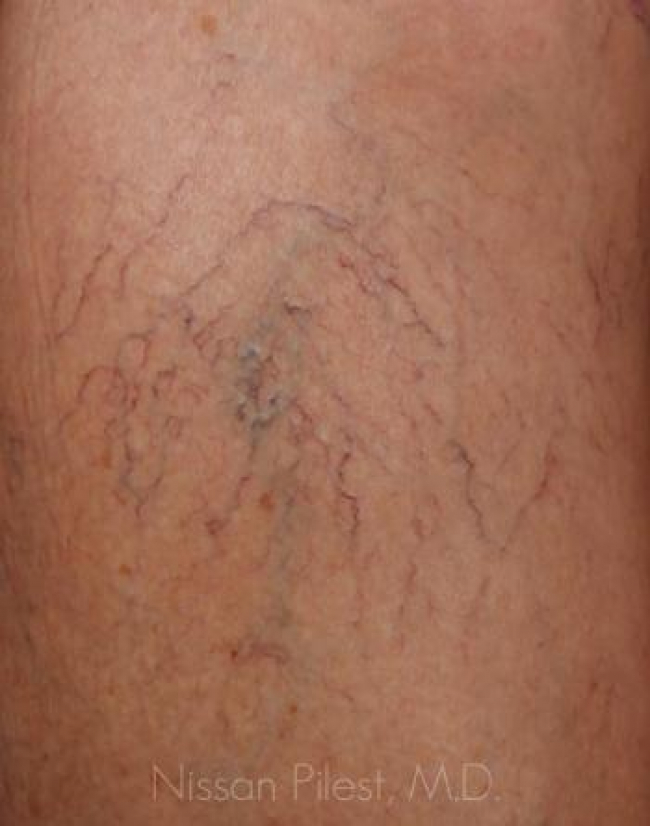 Veins Redness Before & After Image