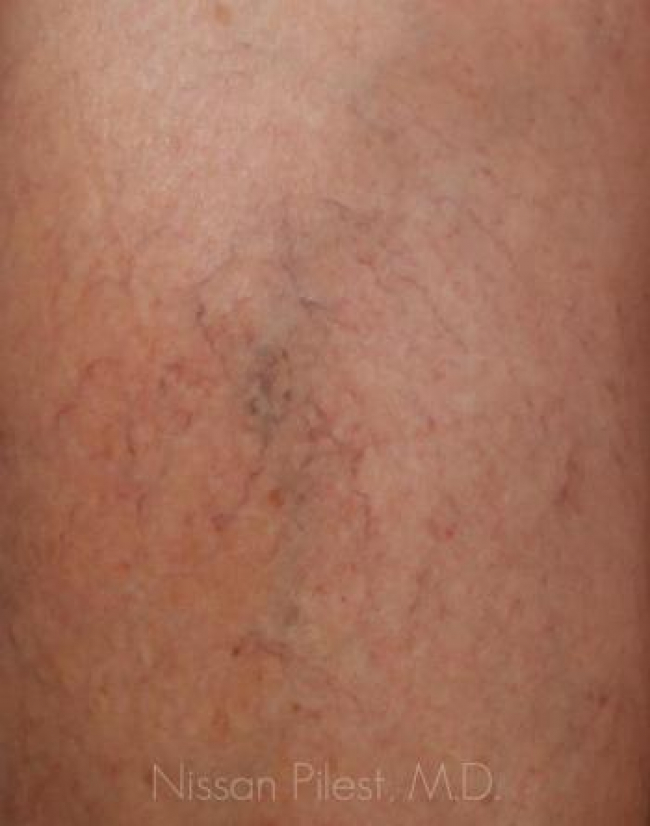 Veins Redness Before & After Image