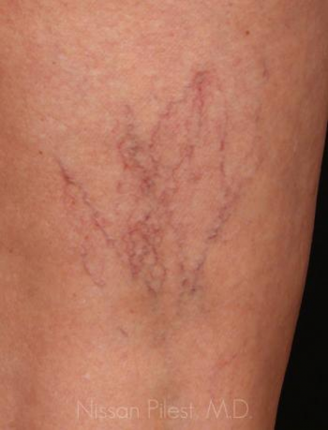 Veins Redness Before & After Image