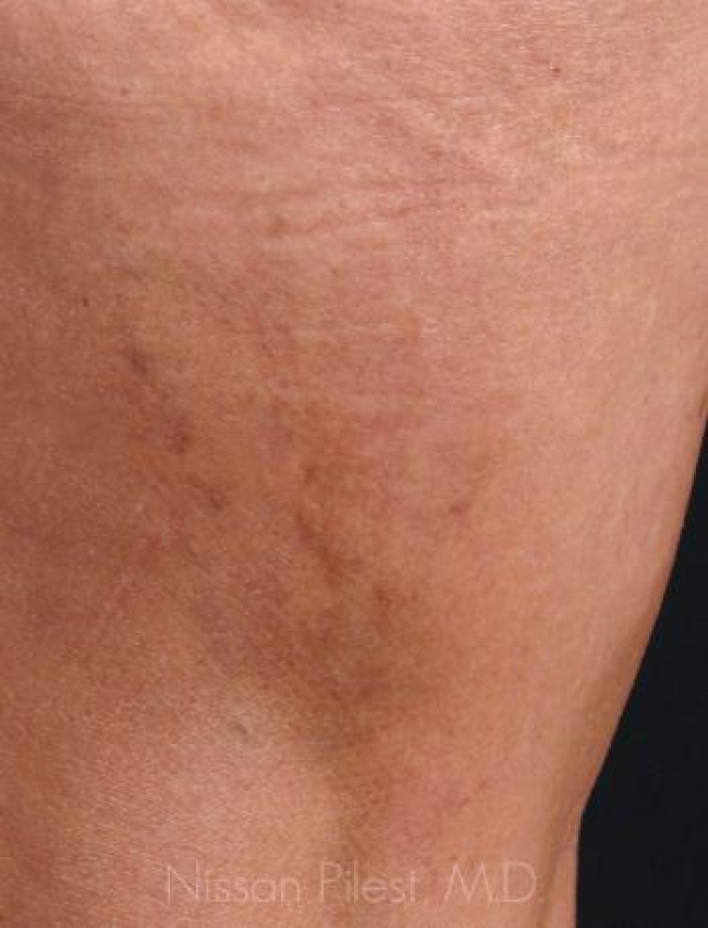 Veins Redness Before & After Image