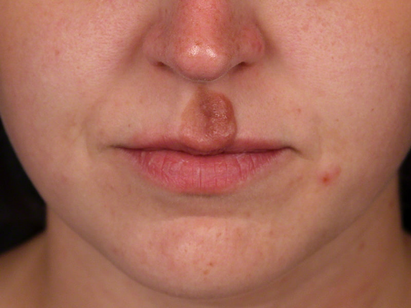 Veins Redness Before & After Image