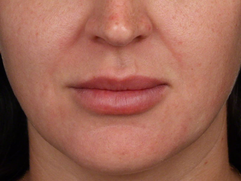 Veins Redness Before & After Image