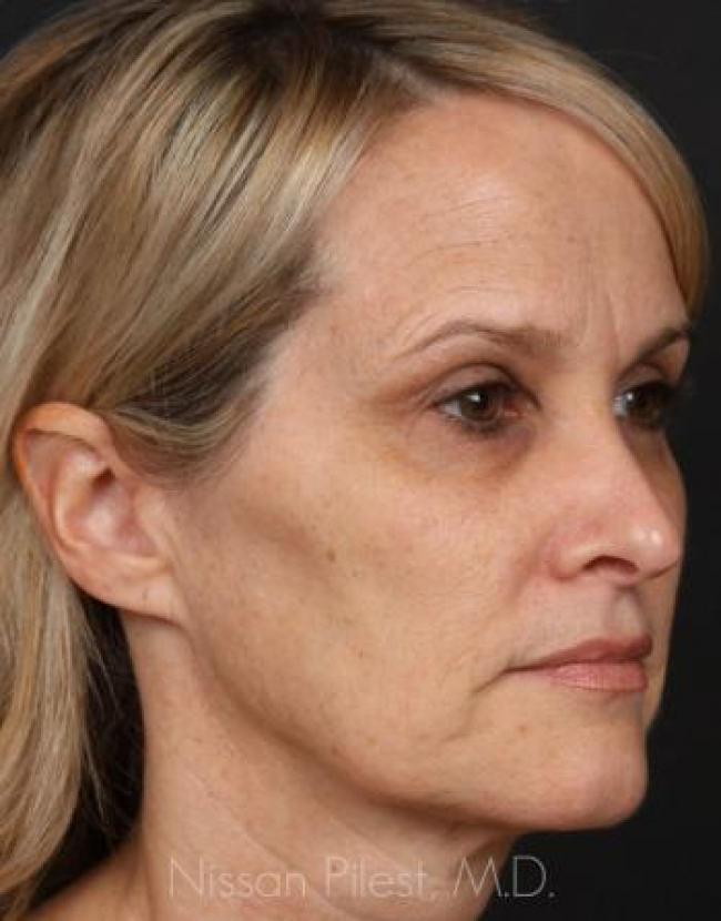 Injectables Before & After Image