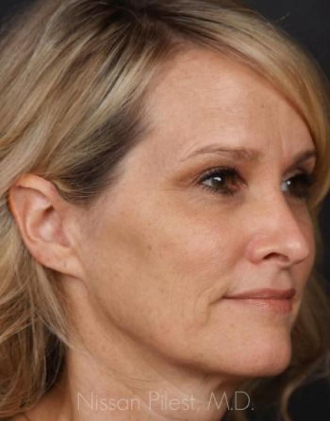 Injectables Before & After Image