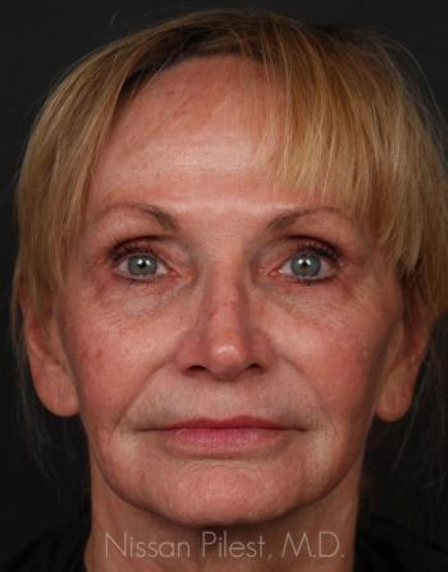 Injectables Before & After Image