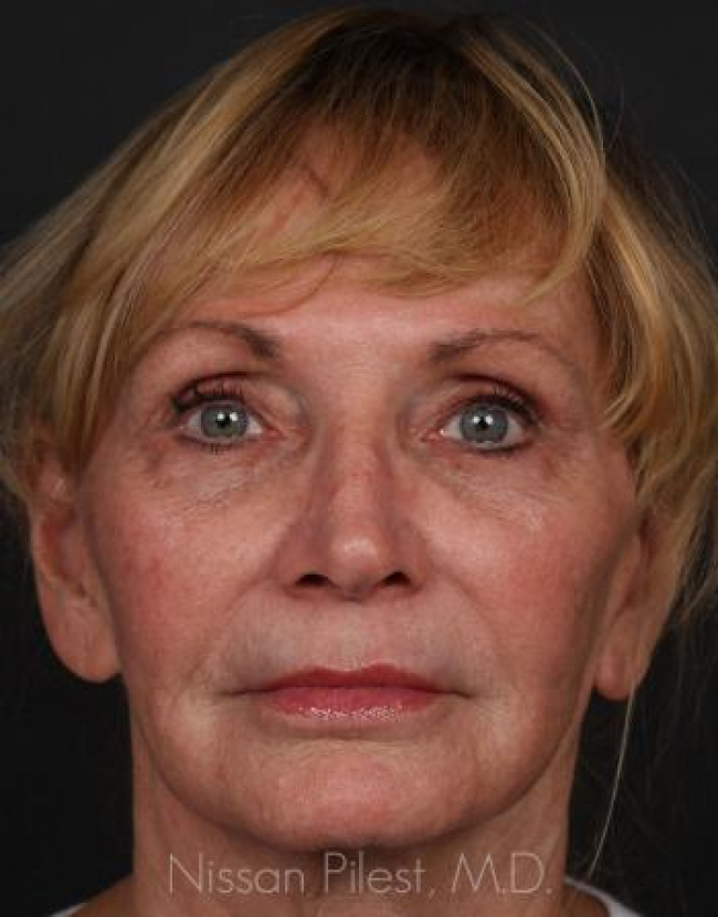 Injectables Before & After Image