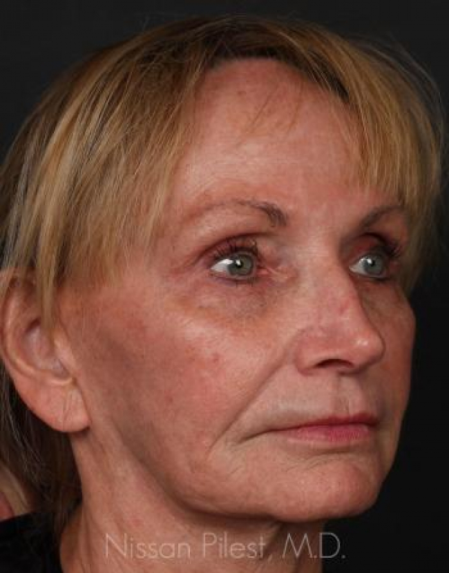 Injectables Before & After Image