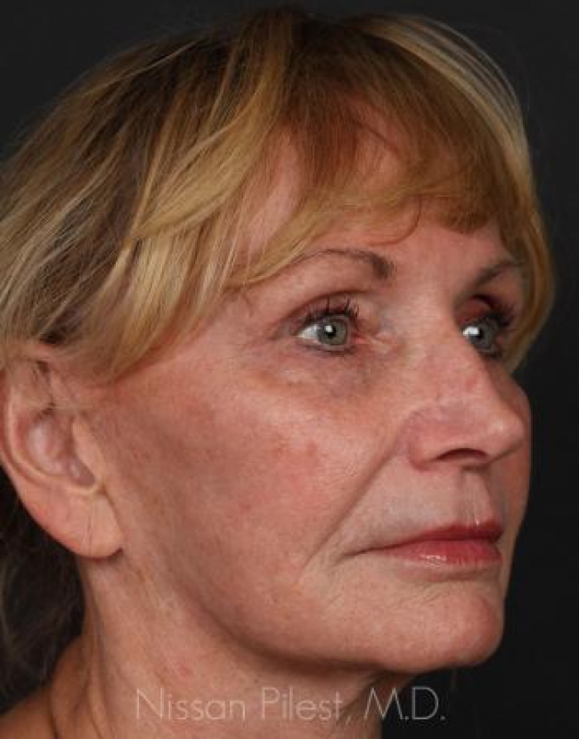 Injectables Before & After Image