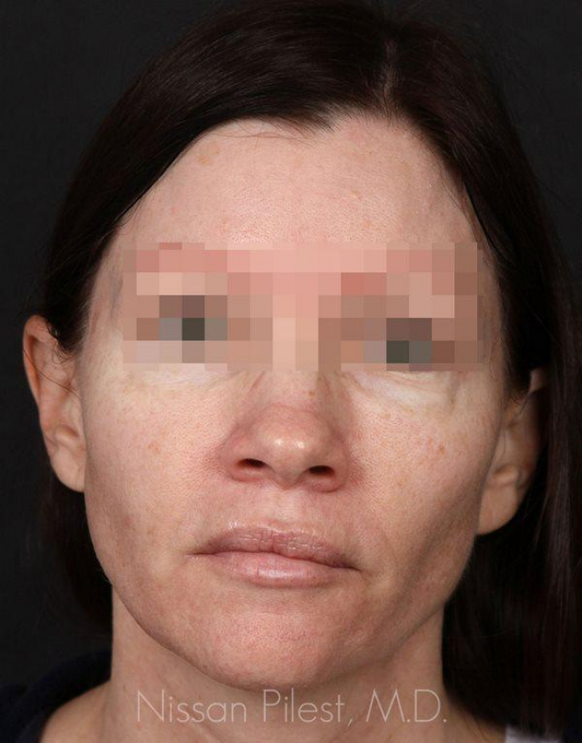 Injectables Before & After Image