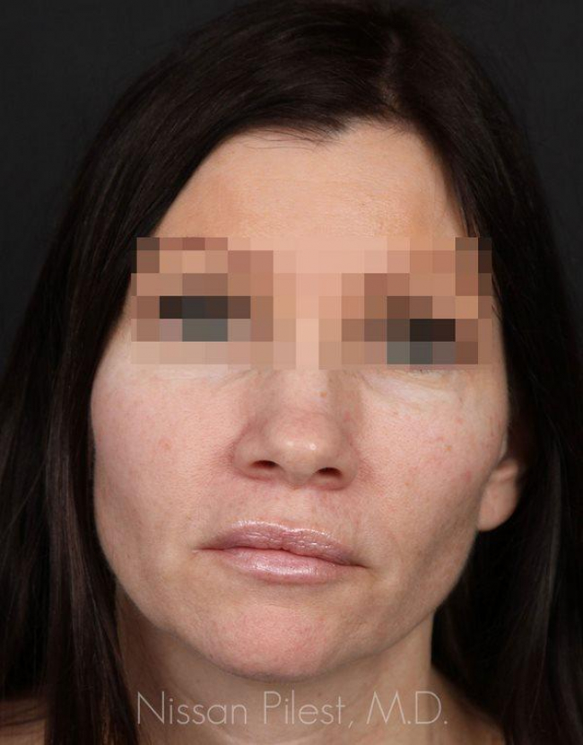 Injectables Before & After Image