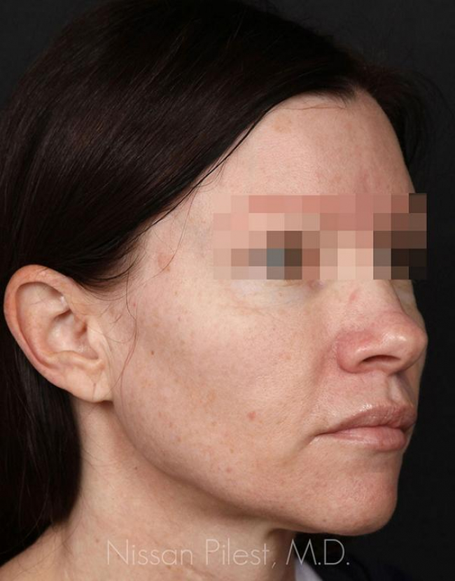 Injectables Before & After Image