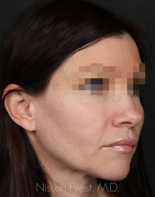 Injectables Before & After Image