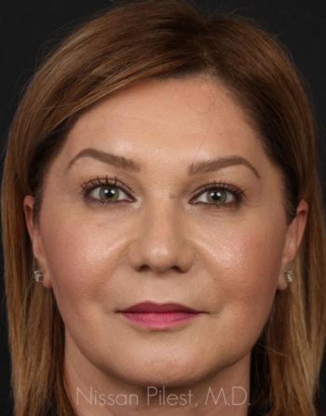 Injectables Before & After Image