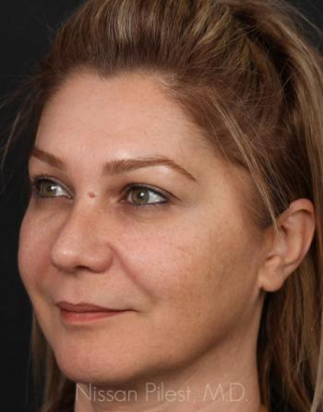 Injectables Before & After Image