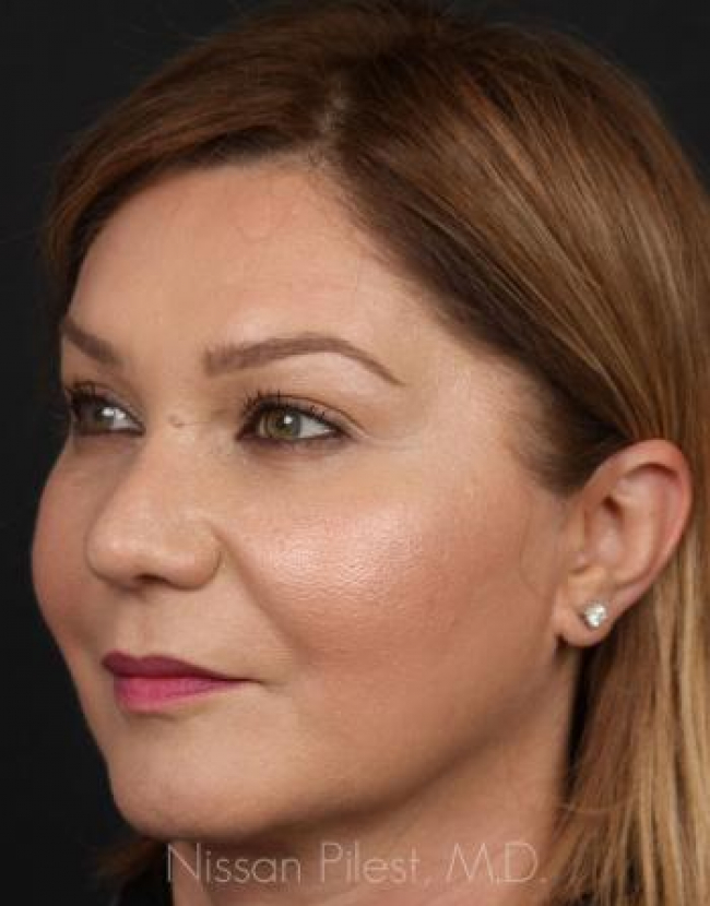 Injectables Before & After Image