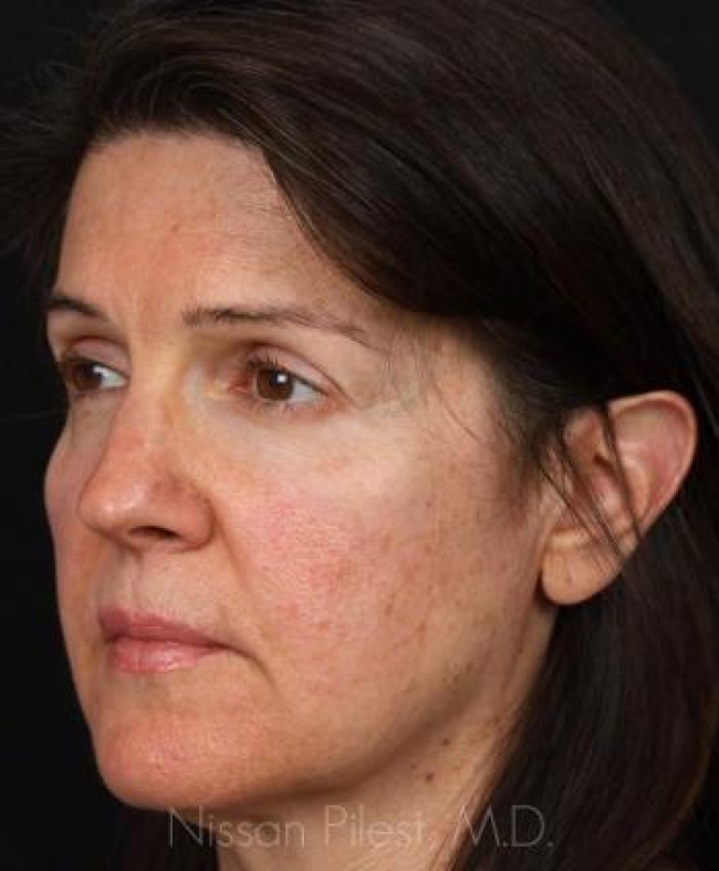 Juvederm Before & After Image