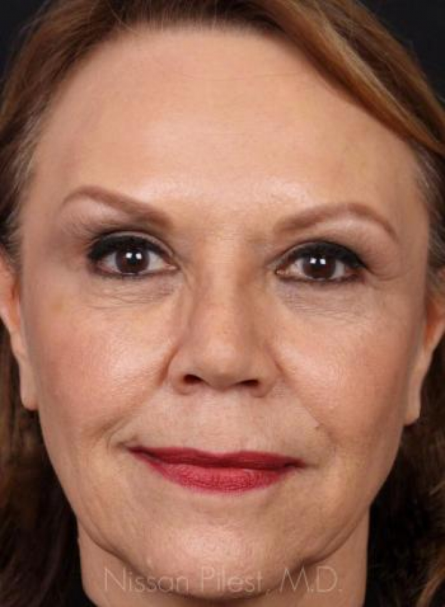 Juvederm Before & After Image