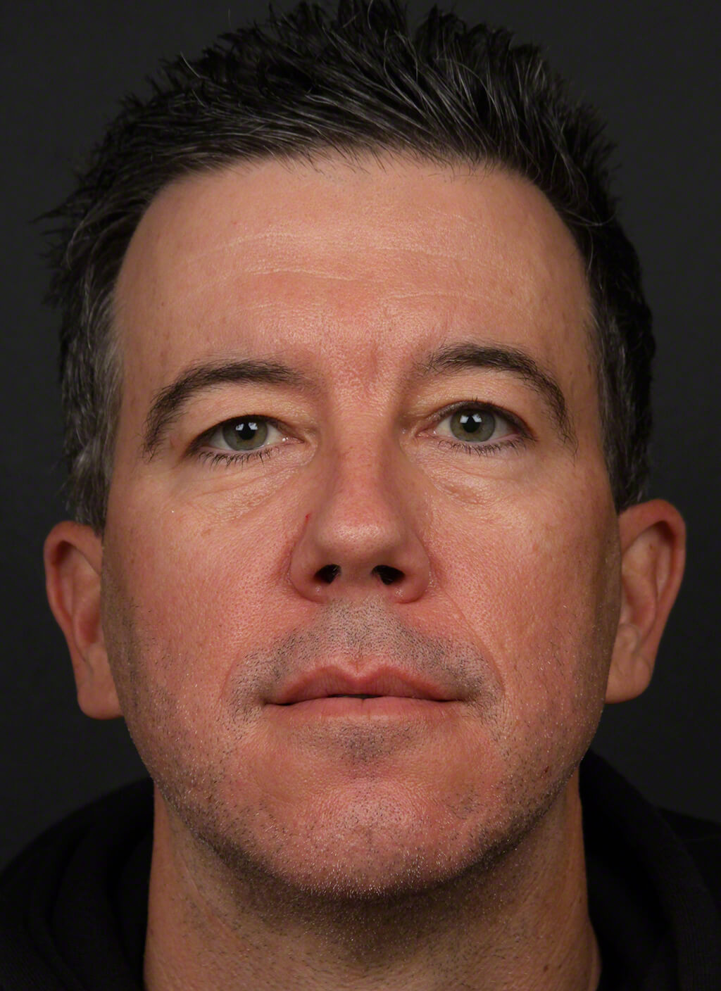 Restylane Before & After Image