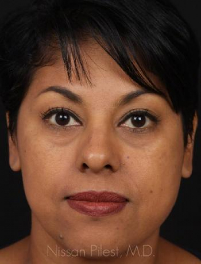 Restylane Before & After Image