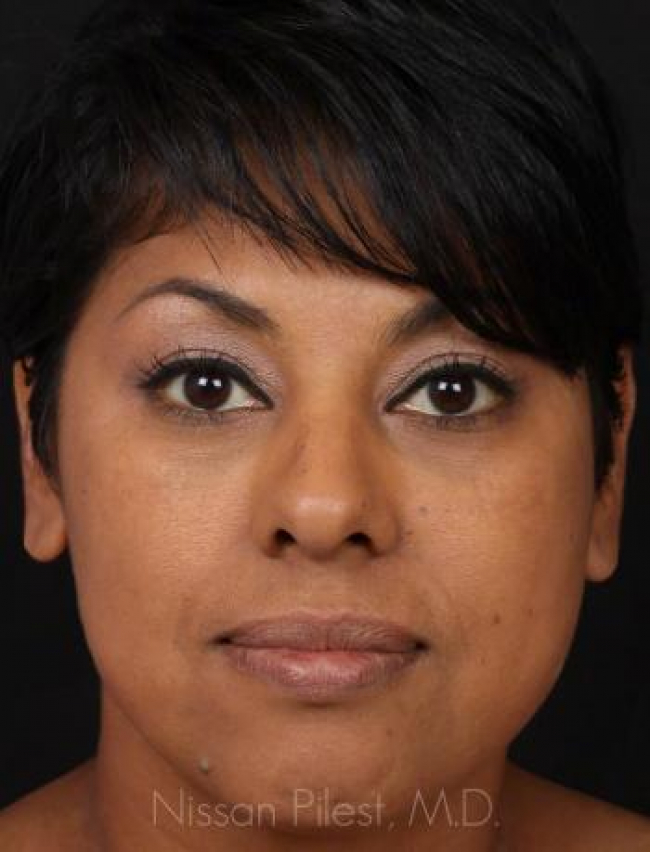 Restylane Before & After Image