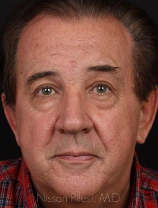 Restylane Before & After Image