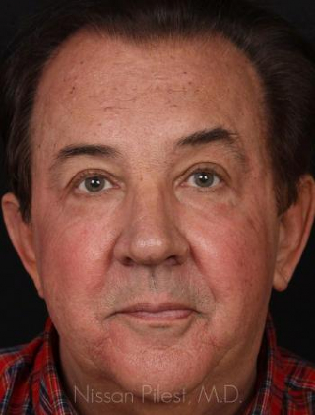 Restylane Before & After Image