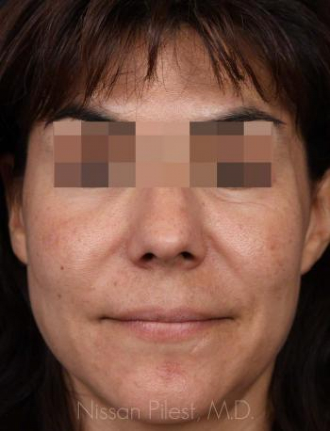 Sculptra Before & After Image